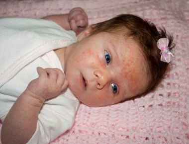 Τι είναι το σύνδρομο Turner και γιατί εμφανίζεται στα κορίτσια